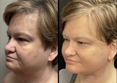 Before After