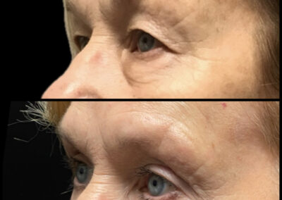 Before After