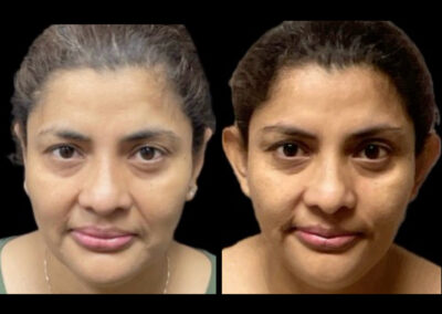 Before After