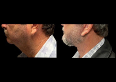 Before After