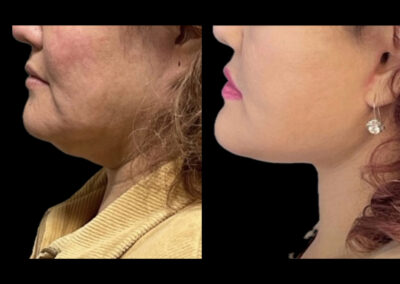 Before After
