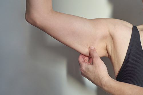 Arm Lift (Brachioplasty)