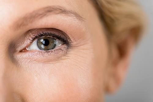 Blepharoplasty