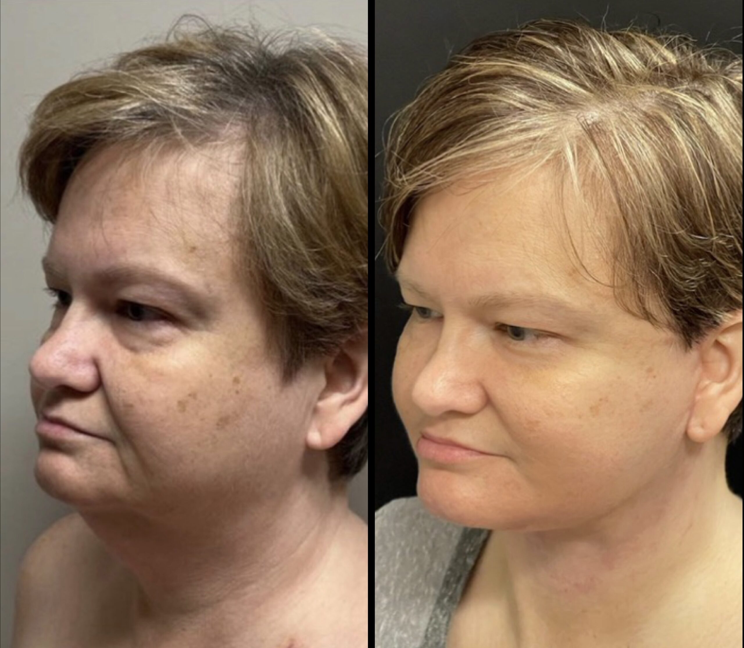 Face Lift 4