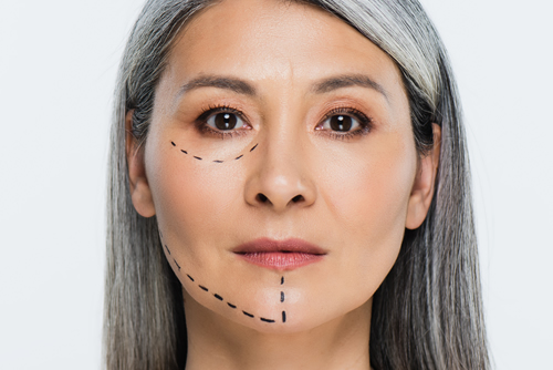 Facelift