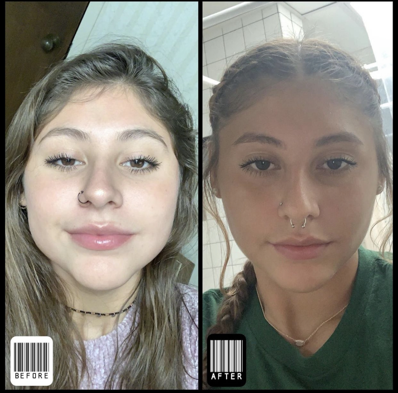 Buccal Fat 2