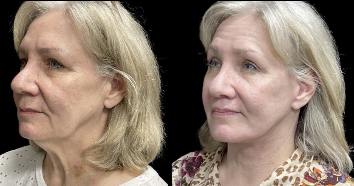 Face Lift 3