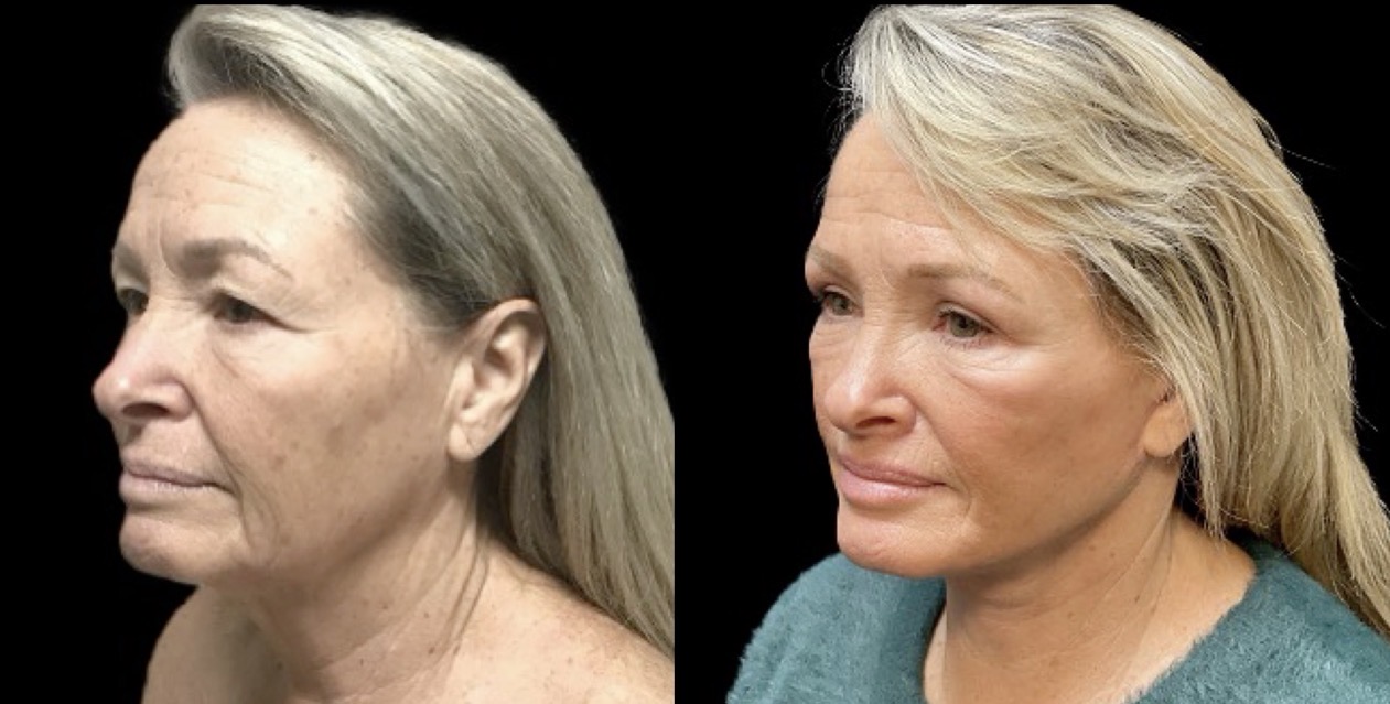 Face Lift 2