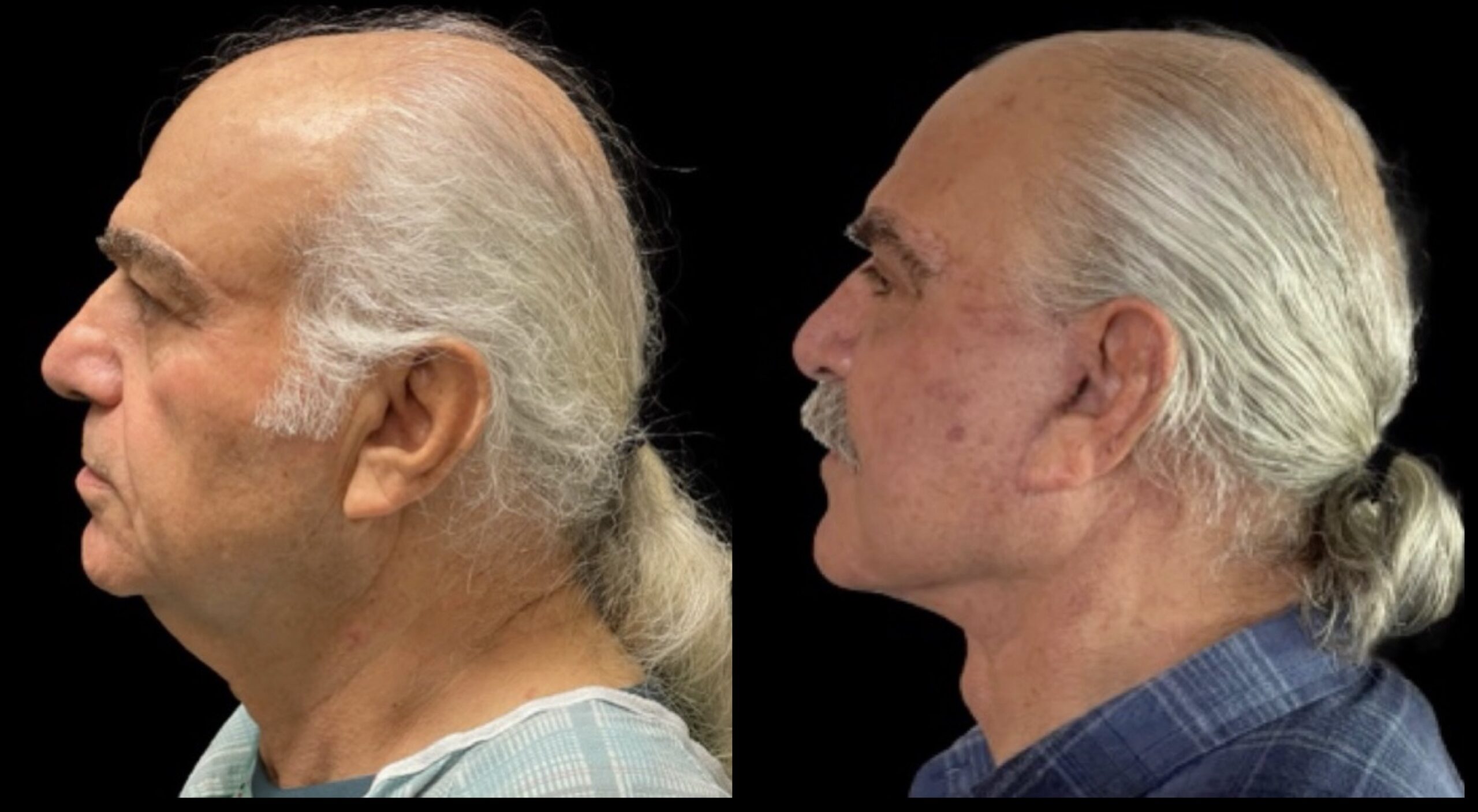 Face Lift 1
