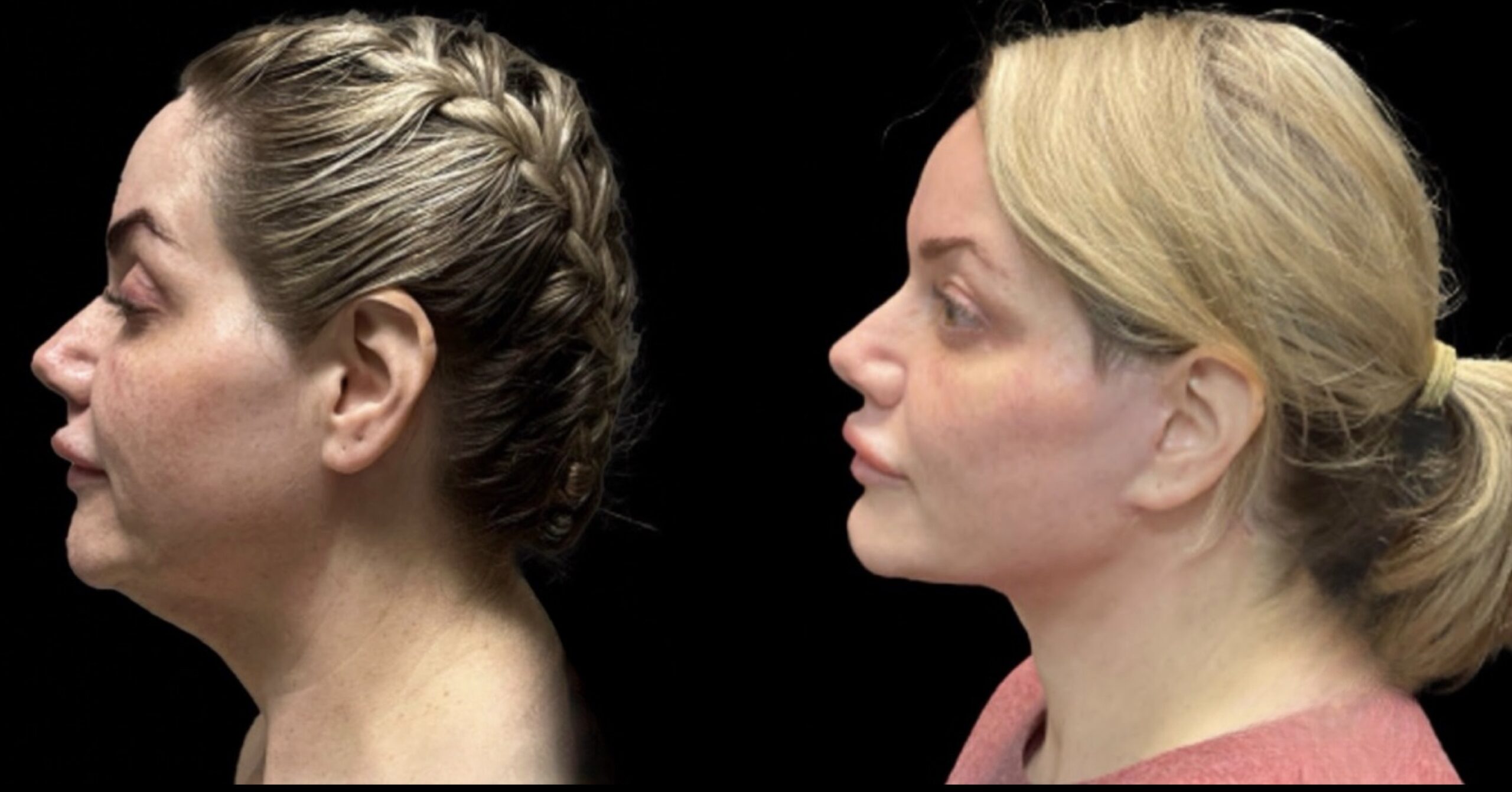 Face Lift 9