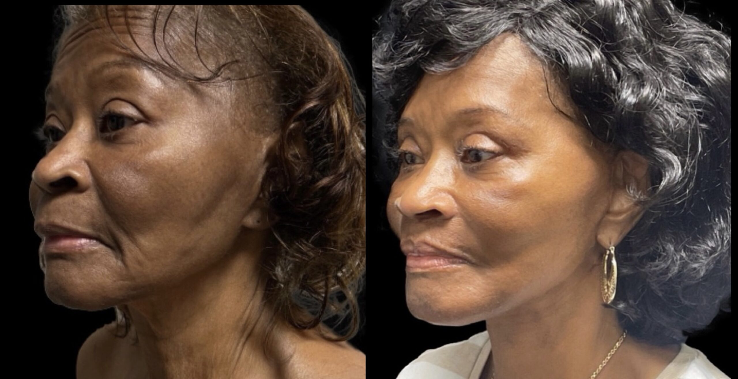 Facial Rejuvenation 2