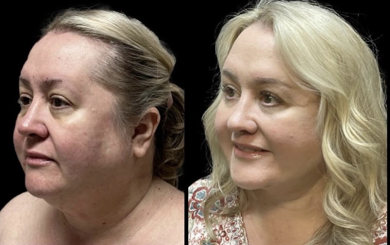 Facial Rejuvenation 3