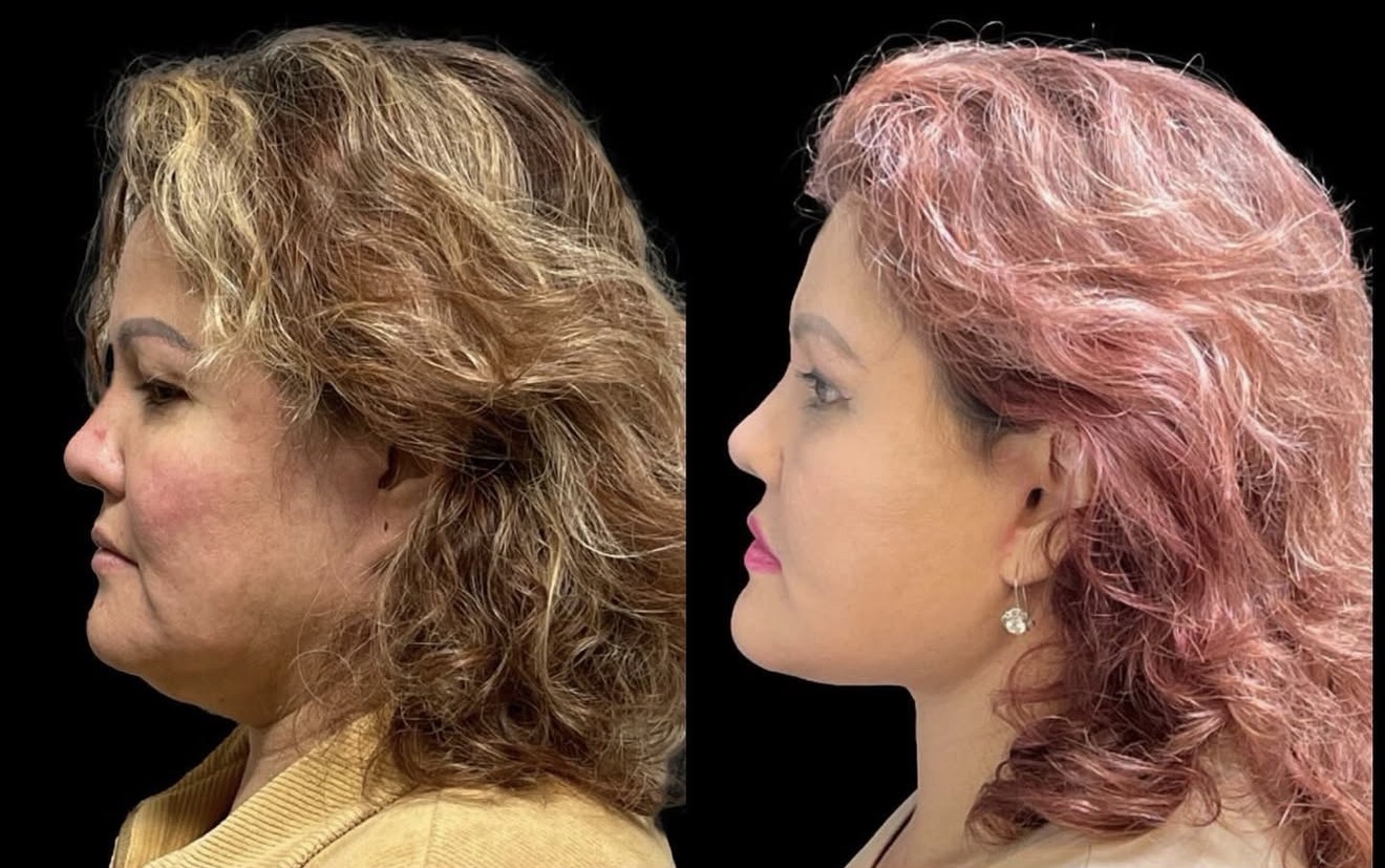 Facial Rejuvenation 4
