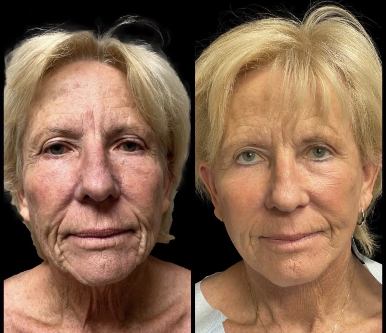 Face Lift 6