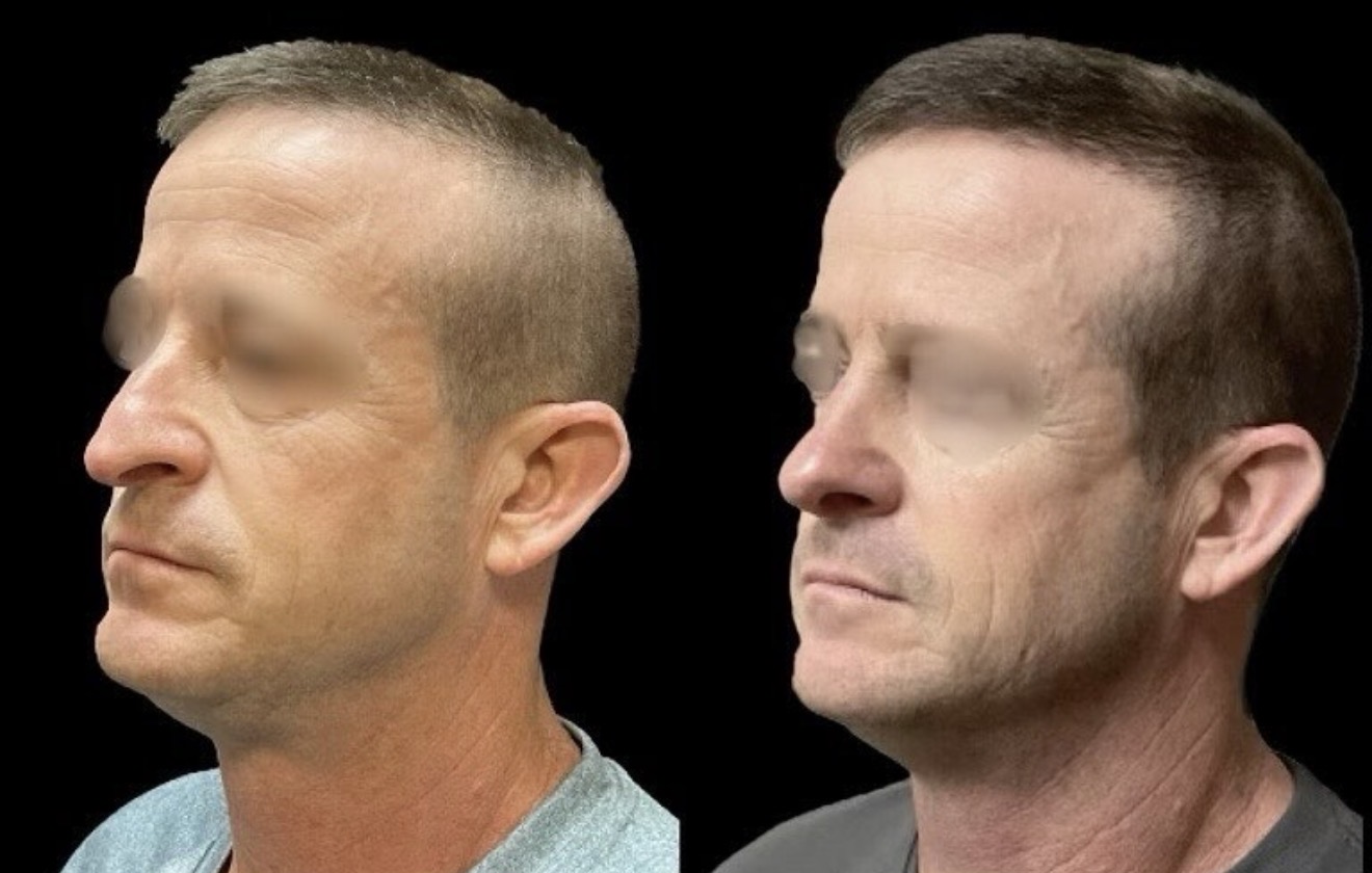 Rhinoplasty 3