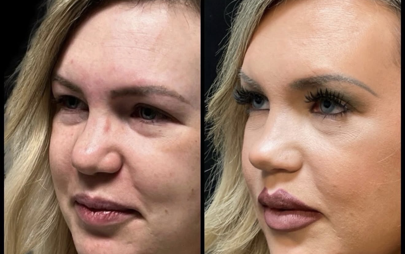 Rhinoplasty 4
