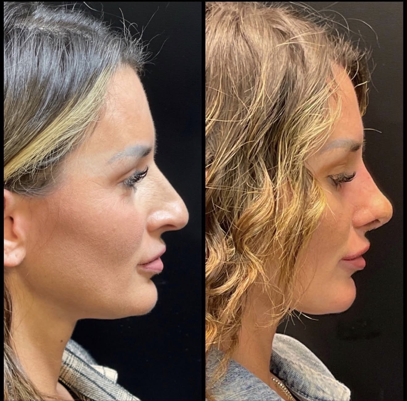 Rhinoplasty 2