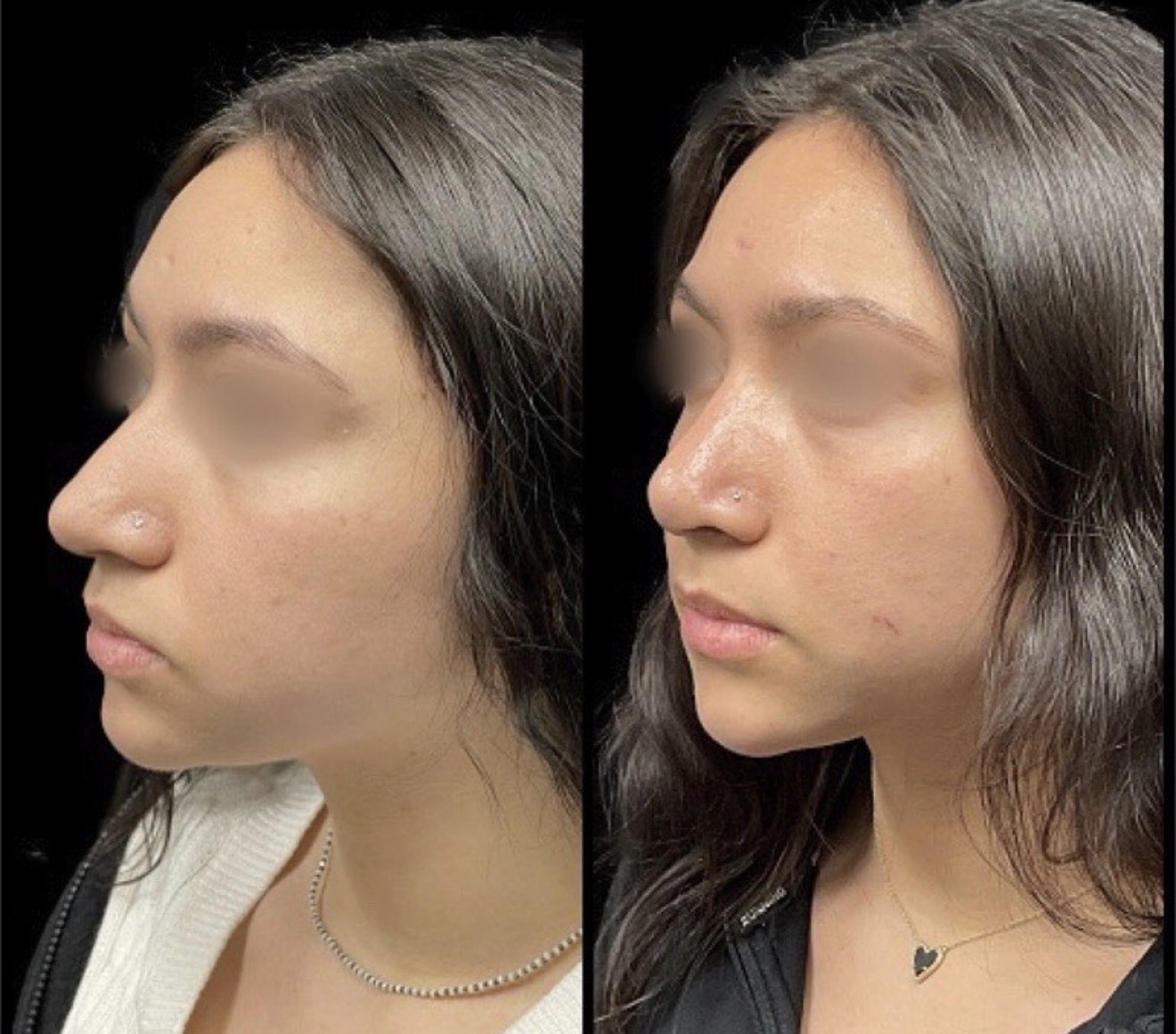Rhinoplasty 1