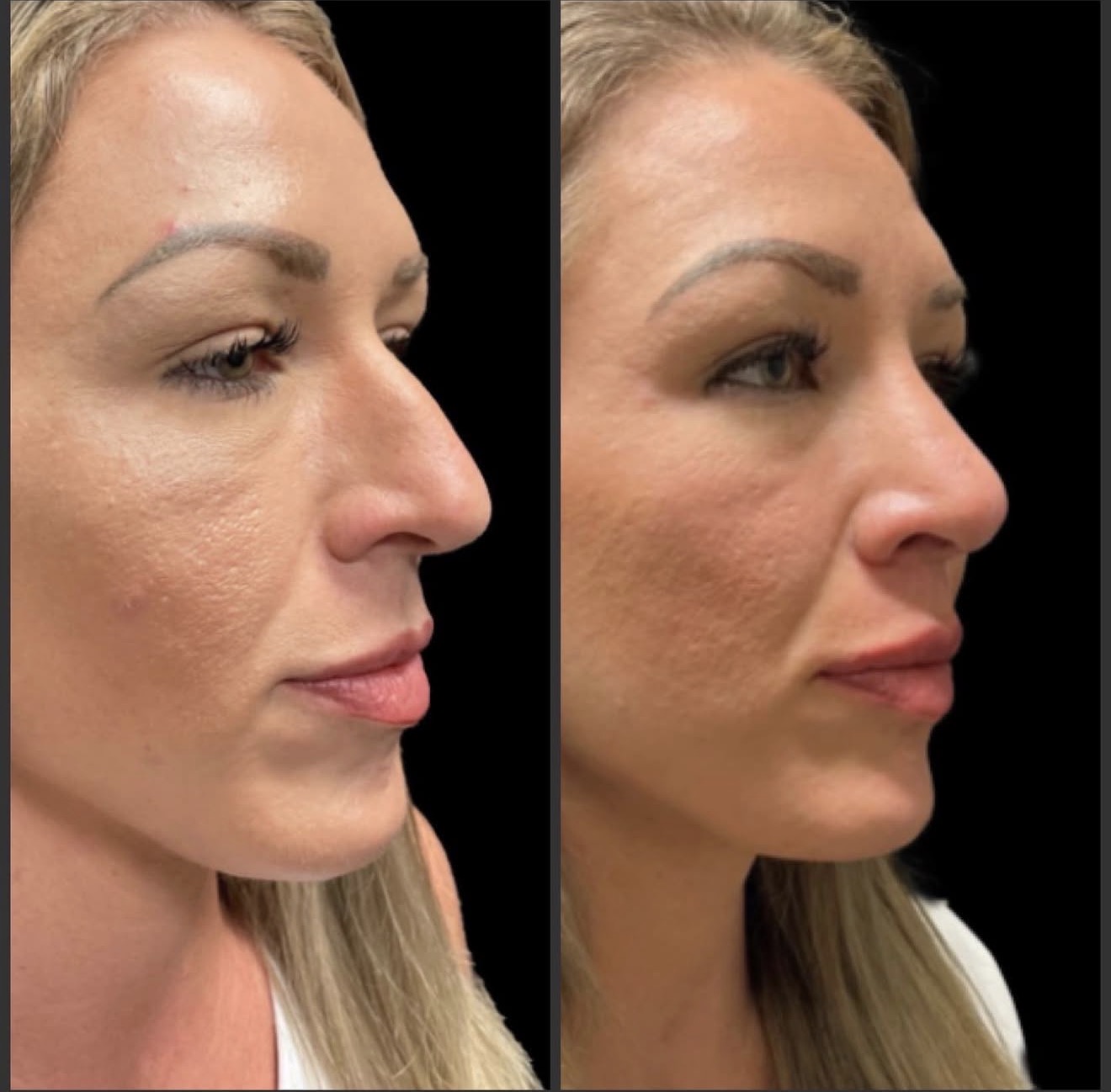 Rhinoplasty 6