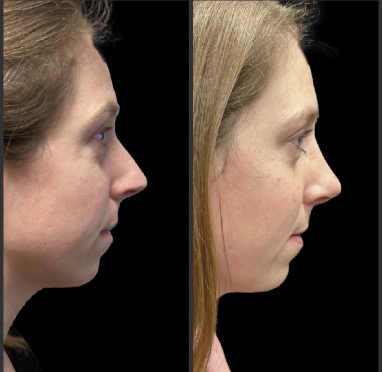 Rhinoplasty 5