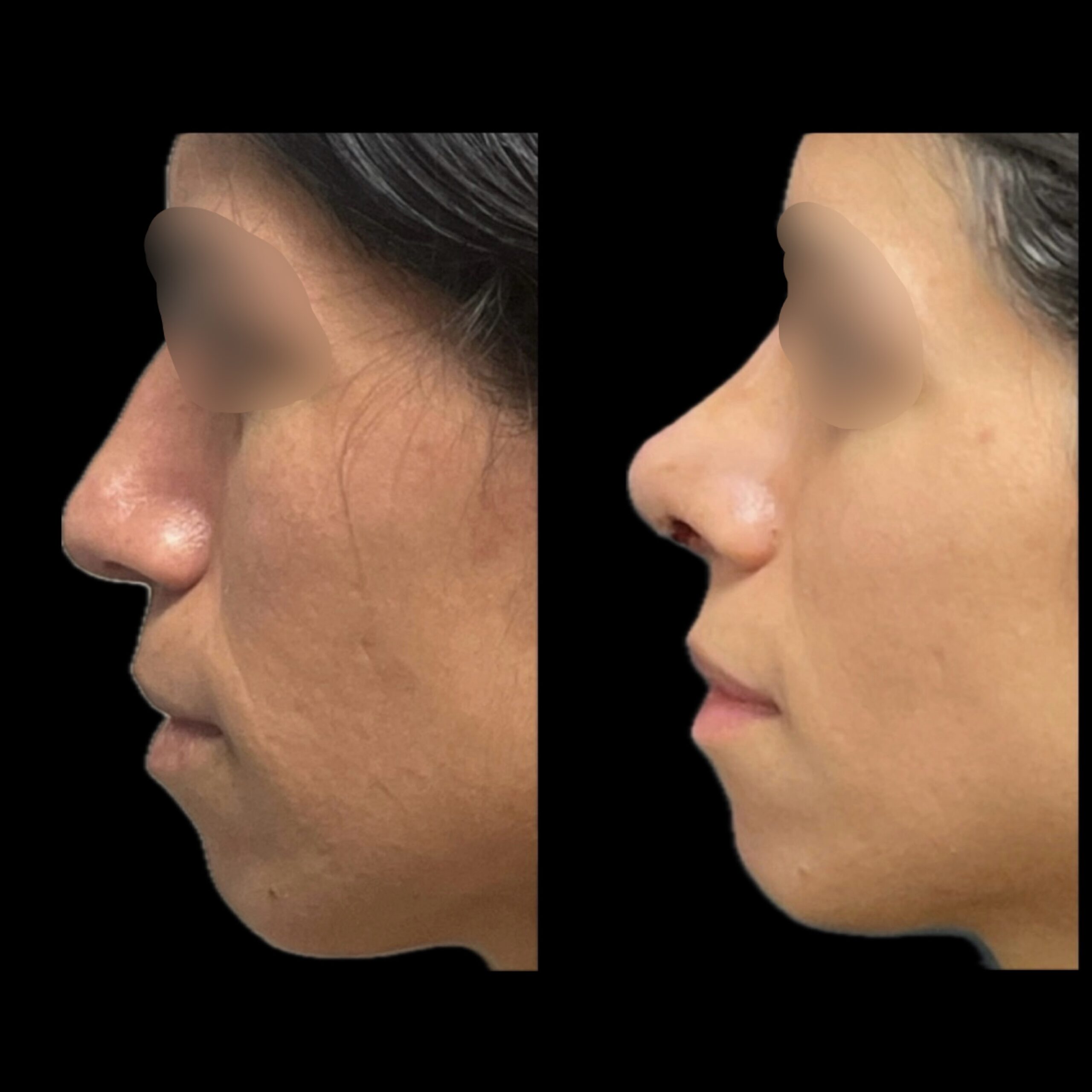 Rhinoplasty 7