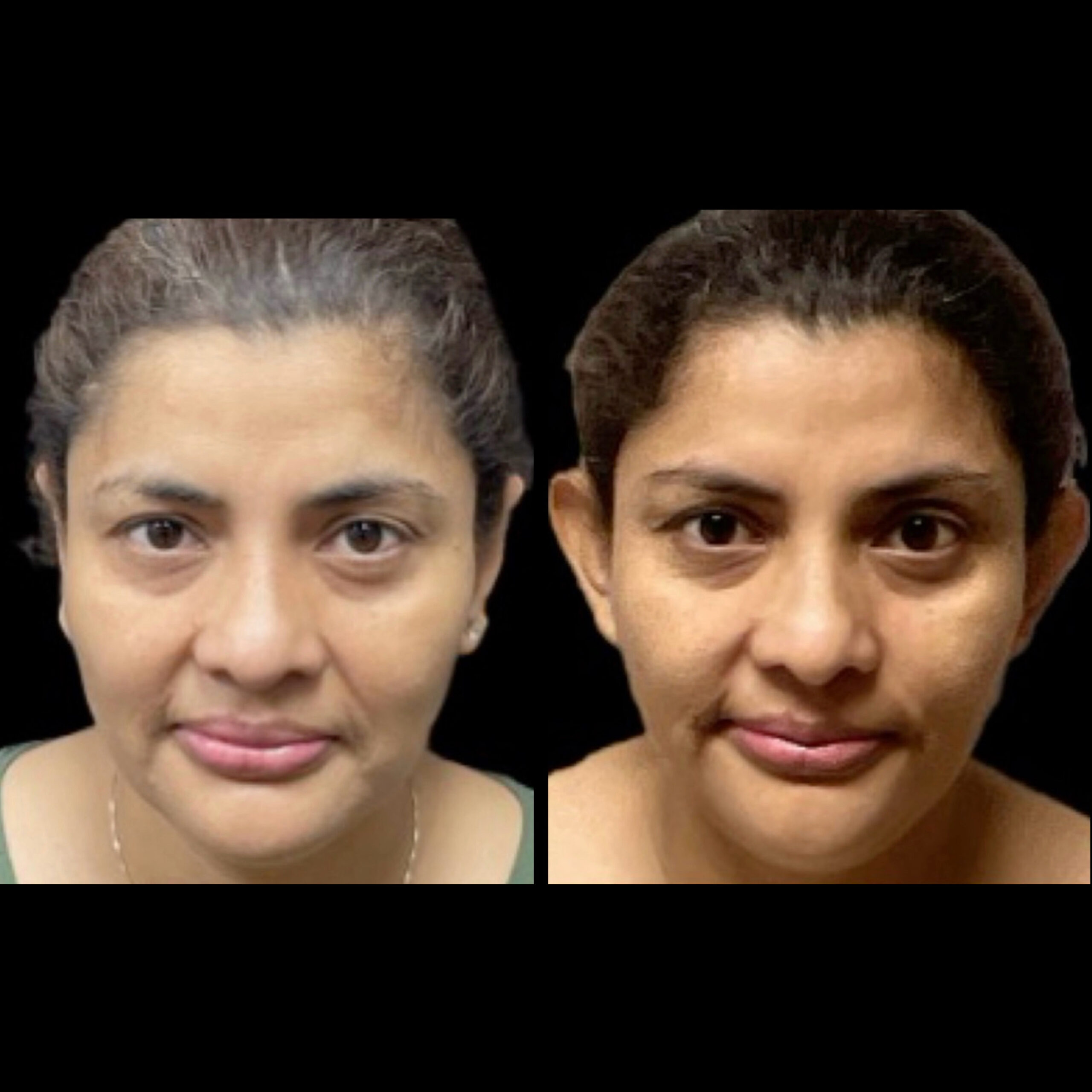 Otoplasty 2