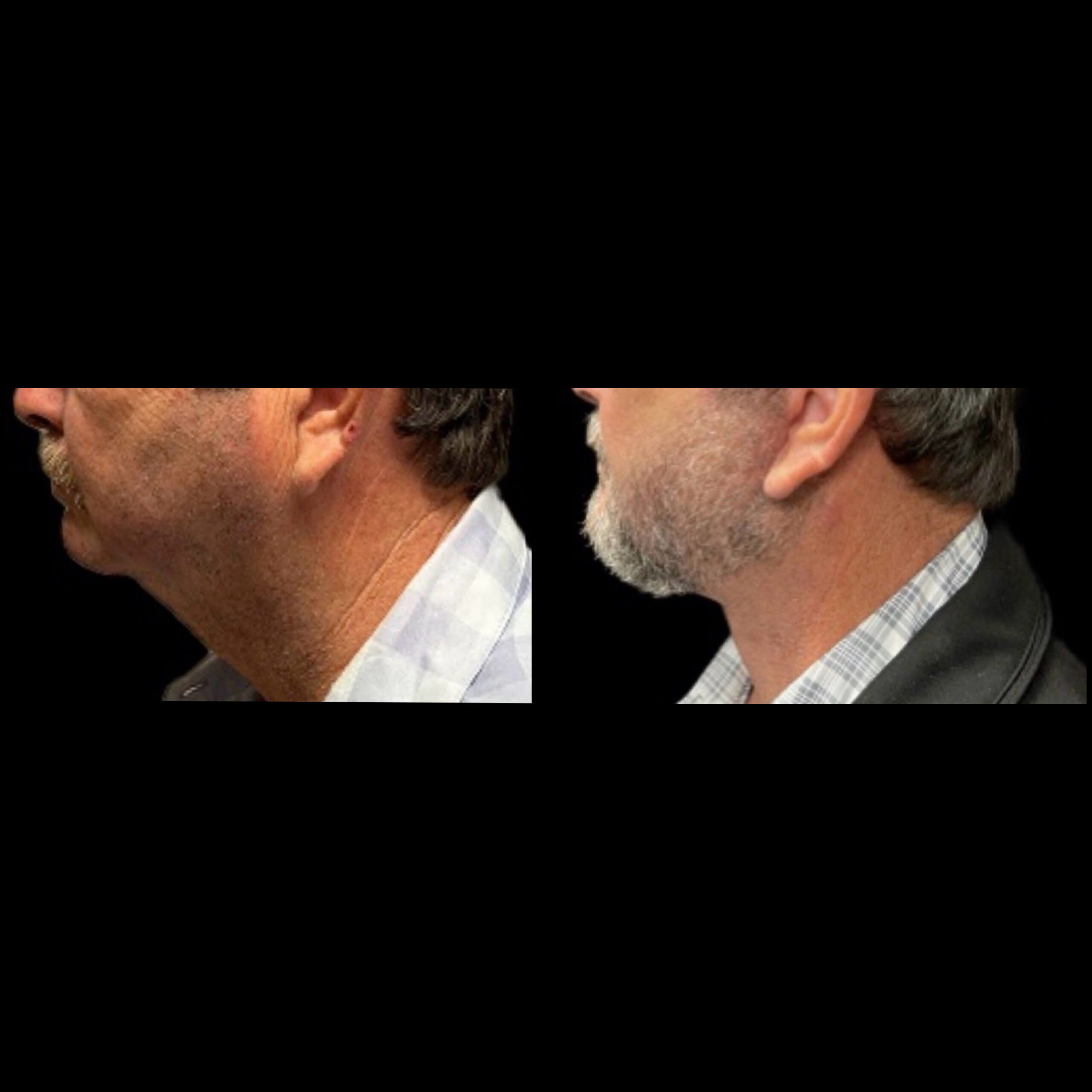 Neck Lift 2