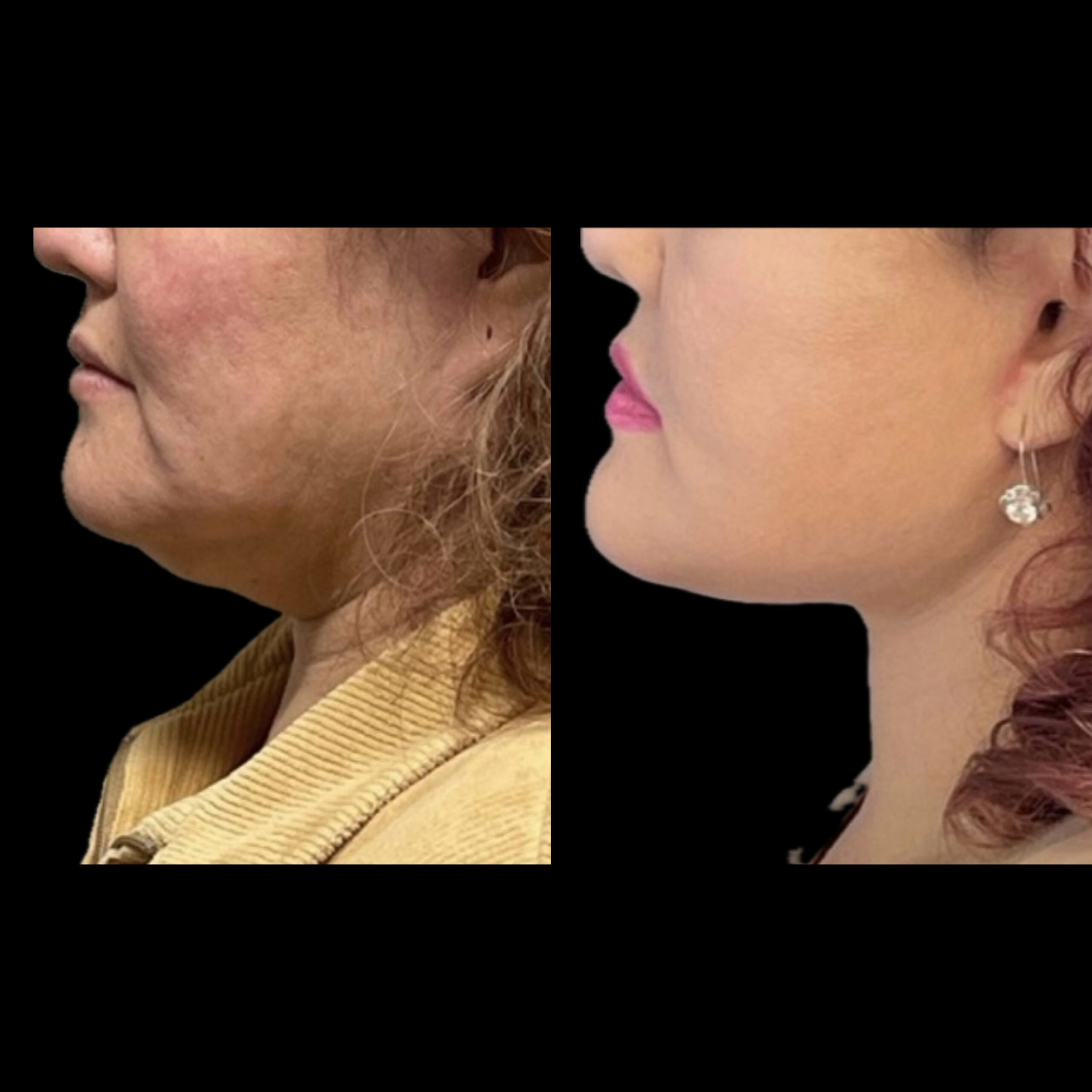 Neck Lift 1