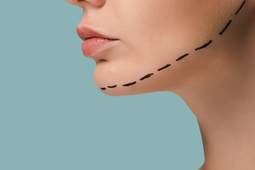 Jawline Implants