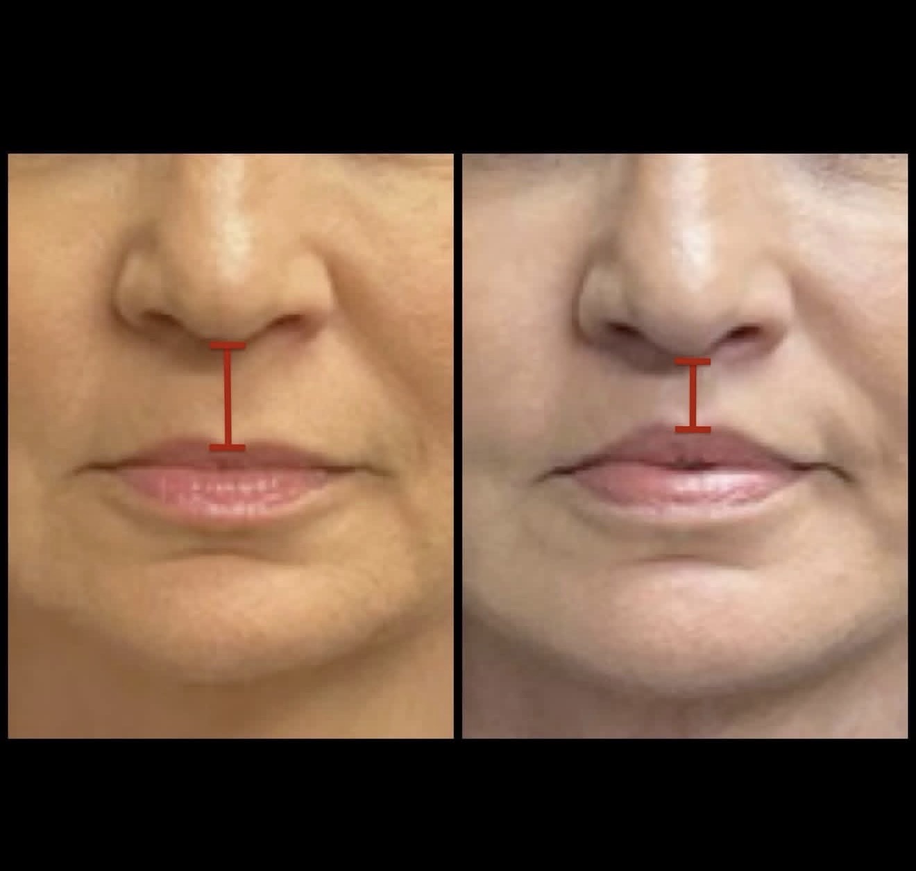 Lip Lift 2