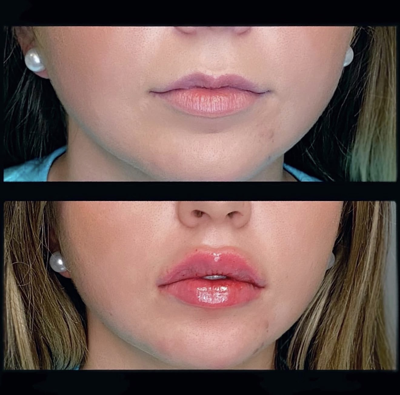 Lip Augmentation 2