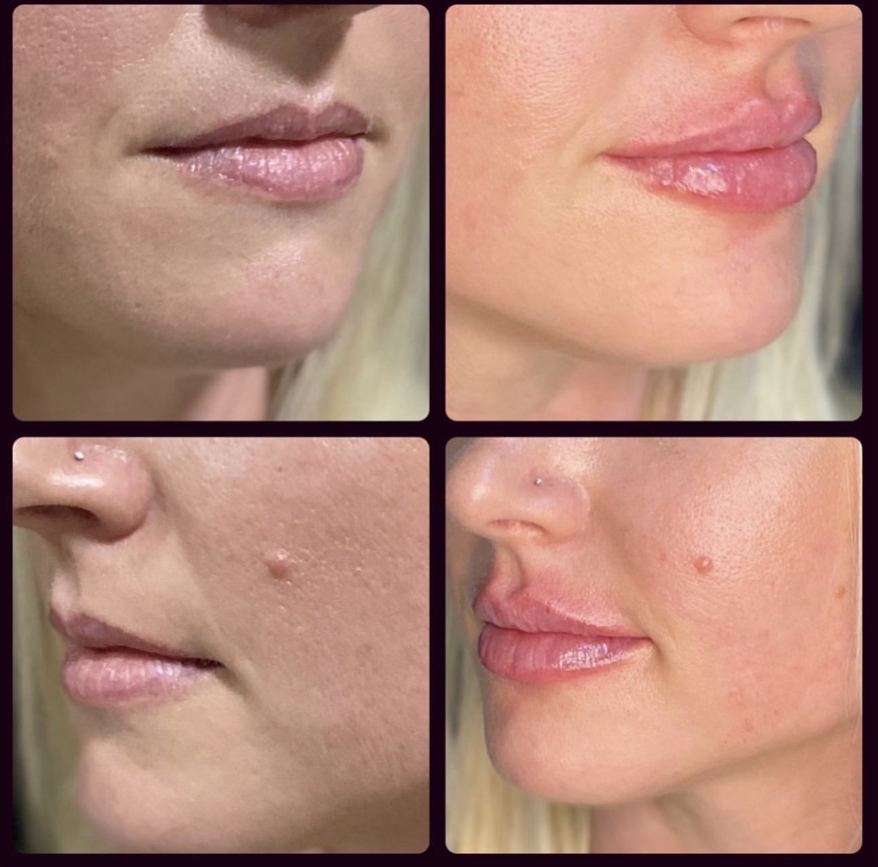 Lip Augmentation 1