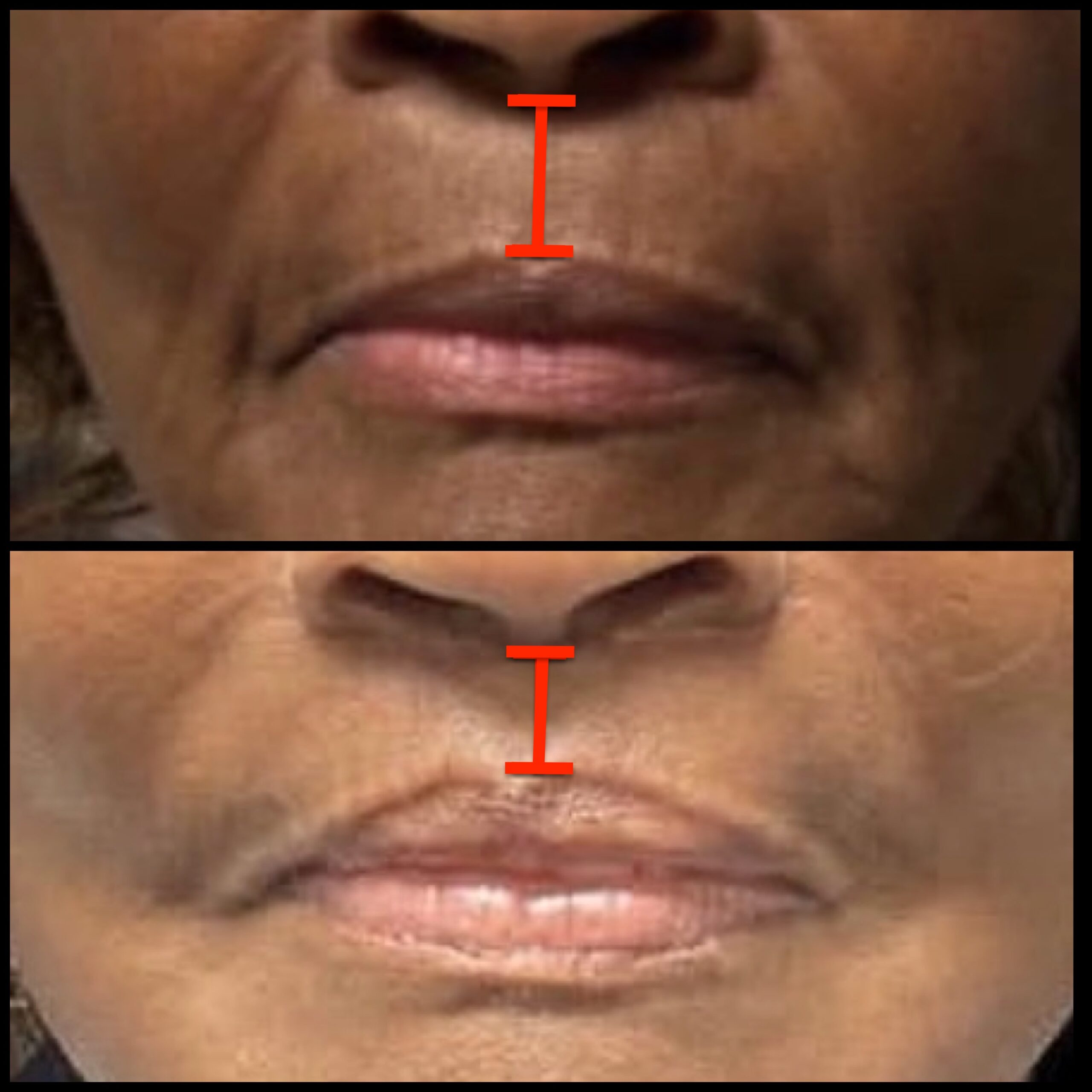 Lip Lift 1