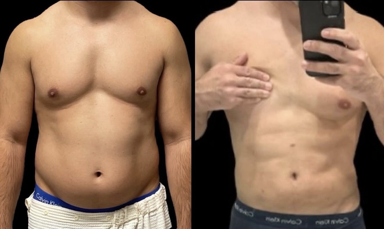 Before After