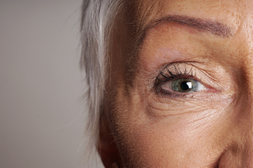 What Is a Brow Lift