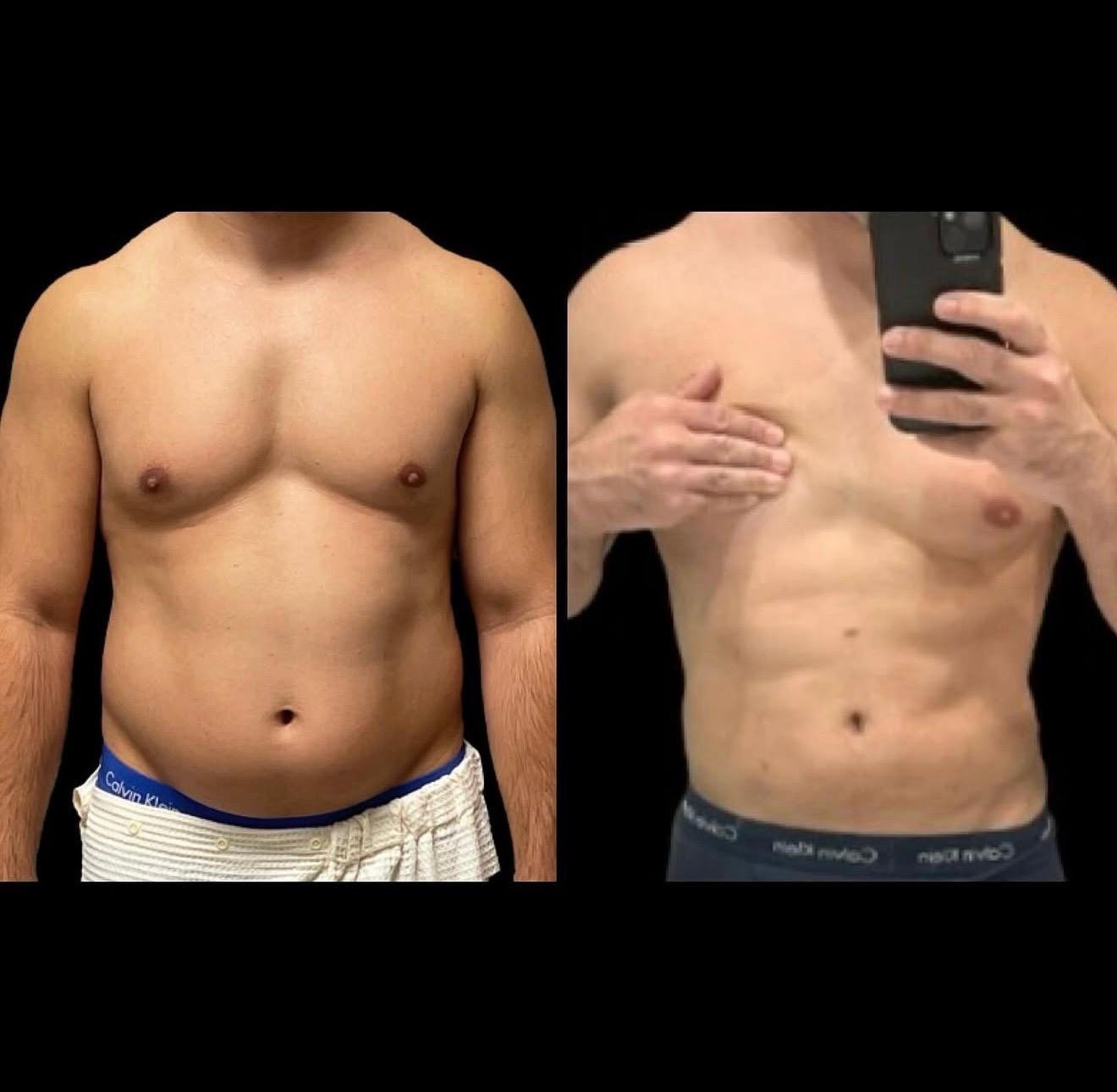 Men Procedures