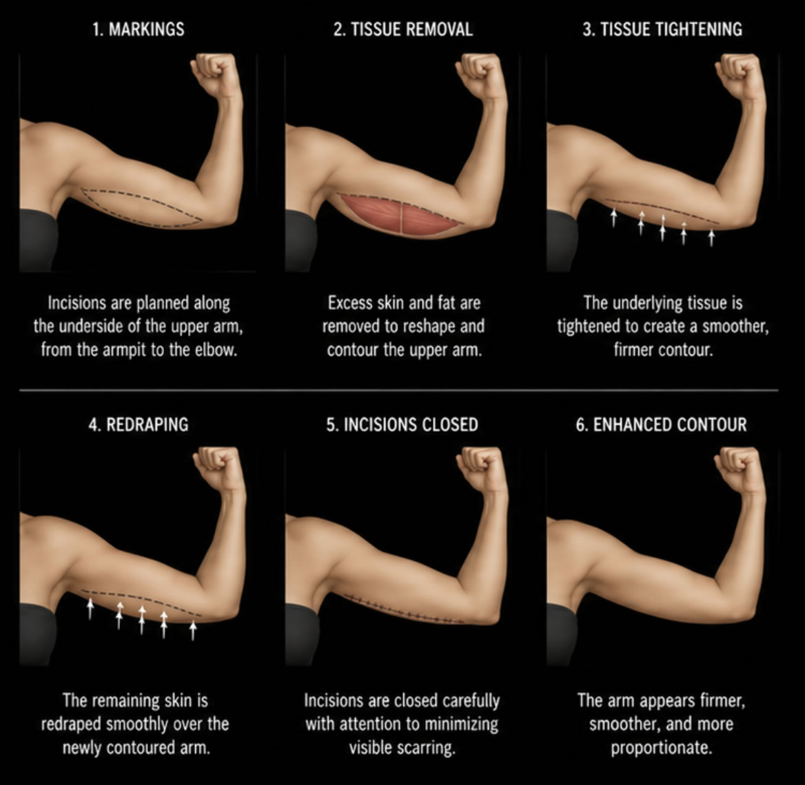 Arm Lift