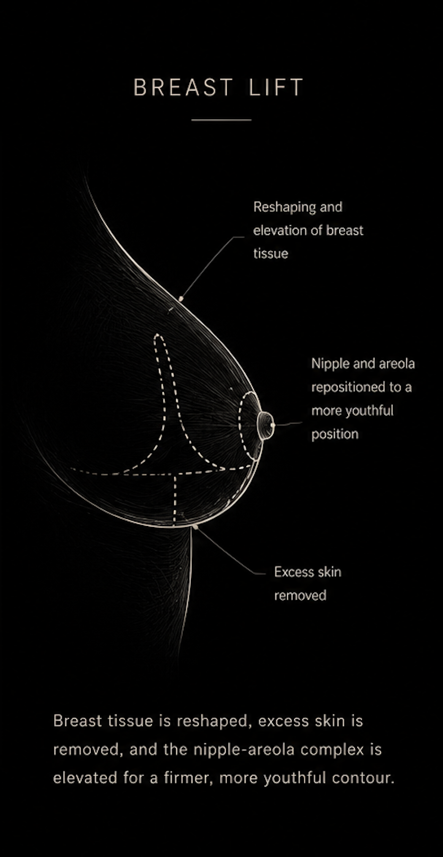 Breast Lift