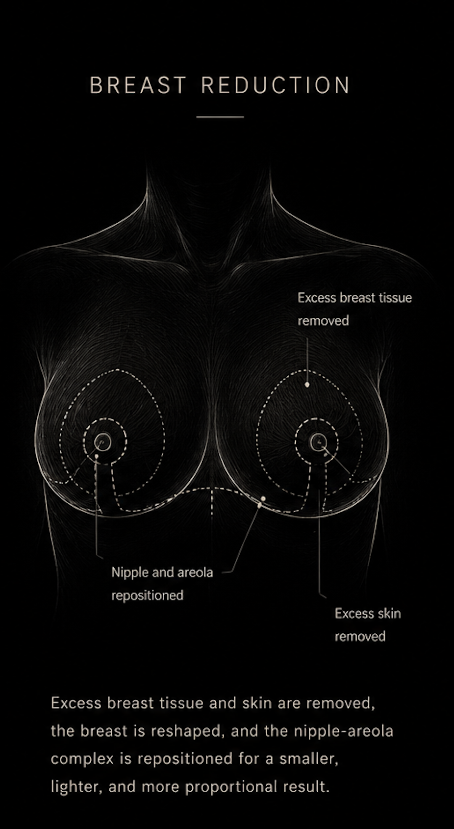 Breast Reduction