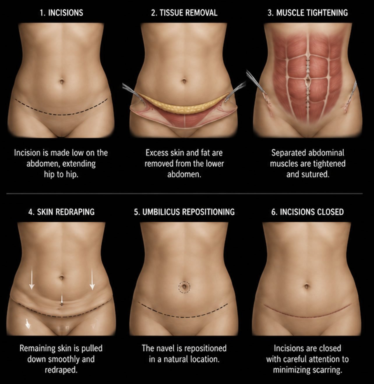 Tummy Tuck